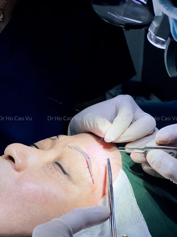 Việc giữ được lâu hay không sau khi nâng cung mày phụ thuộc vào nhiều yếu tố