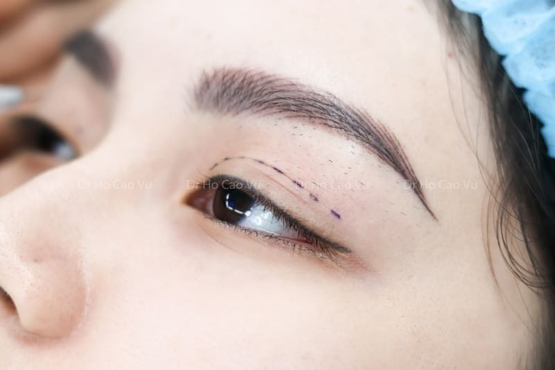 Nhấn mí là gì? Những điều cần biết về phương pháp nhấn mí Hàn Quốc