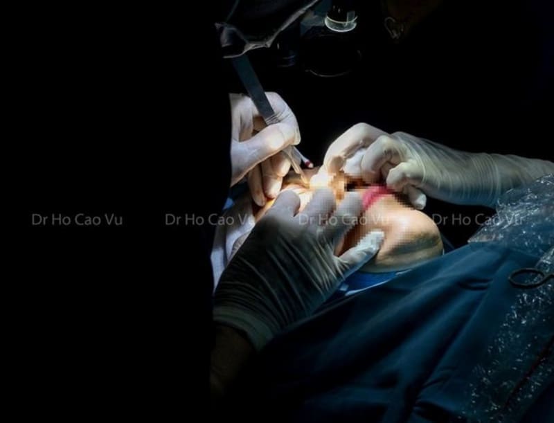 Tư vấn, thăm khám khách nữ trẻ cắt mí không đều, nâng mũi bị lệch vách ngăn